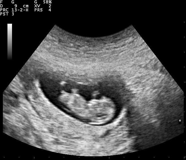 Ultrasound of fetus
